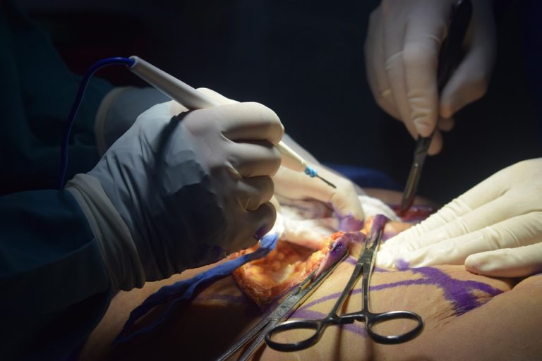 plastic-surgery-4475077_960_720