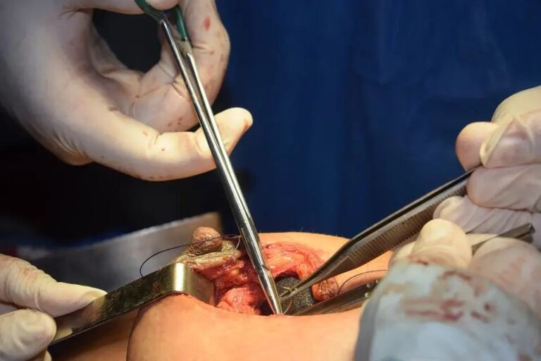 mammoplasty-4475080_960_720