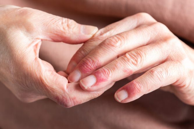 Woman hands with atopic dermatitis, eczema, allergy reaction on skin