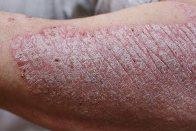 Close up, macro of psoriasis skin, autoimmune disease that affects the skin cause skin inflammation red and scaly. Skin allergy with severe symptoms. Dermatitis rash and ugly eczema.