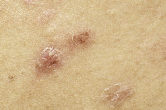 Closeup of squeezed whelks on skin