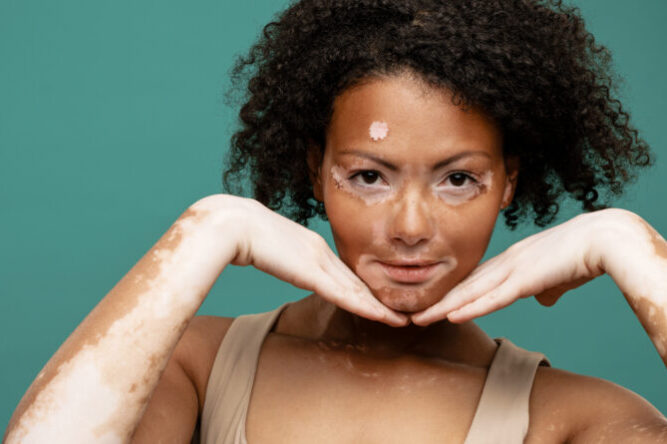 Young woman with vitiligo gesturing and looking at camera