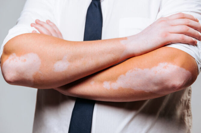 Close up of a human hand with symmetrical spots of vitiligo disease on the skin.