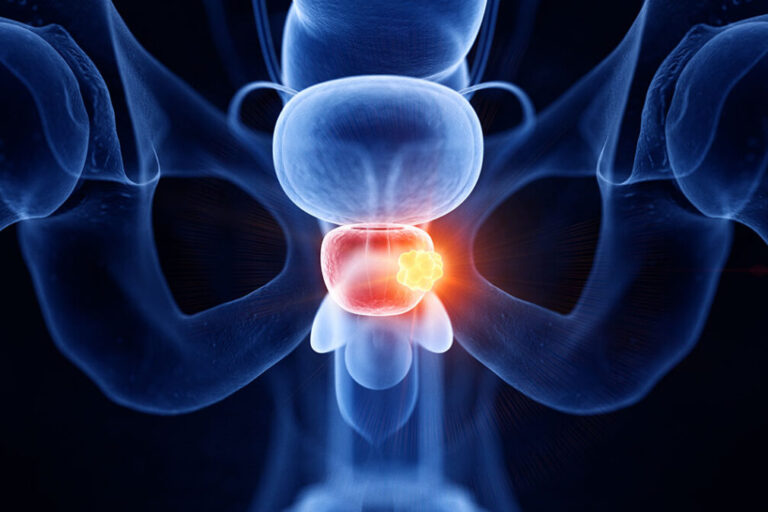 PROSTATA